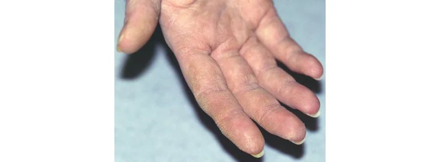 表现为技工手的尿黑酸尿症