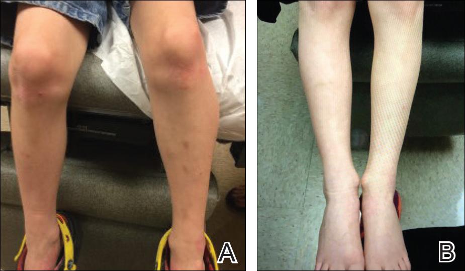 女儿皮炎医生要求打度普利尤单抗,度普利尤单抗治疗儿童特应性皮炎