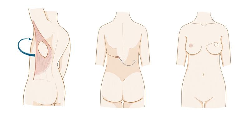 脂肪移植再造乳房的专家,乳房自体脂肪再造存活率