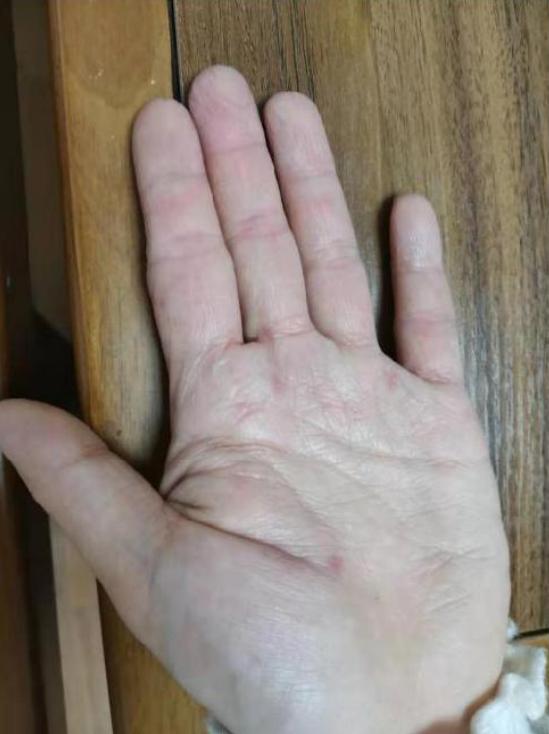 湿疹反复发作找不到病因,湿疹反复发作一招解决