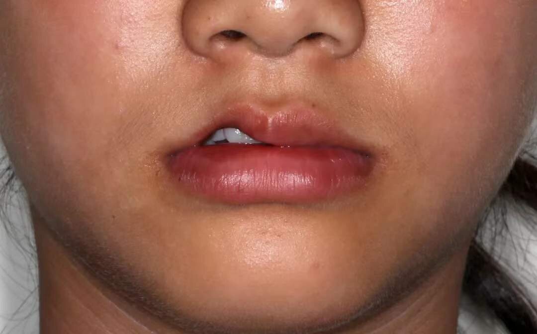 血管瘤八年了没有事可要治疗,30岁得了血管瘤怎么办