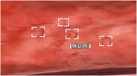 肠息肉转变癌症的概率,肠息肉会变癌吗癌有4个早期信号