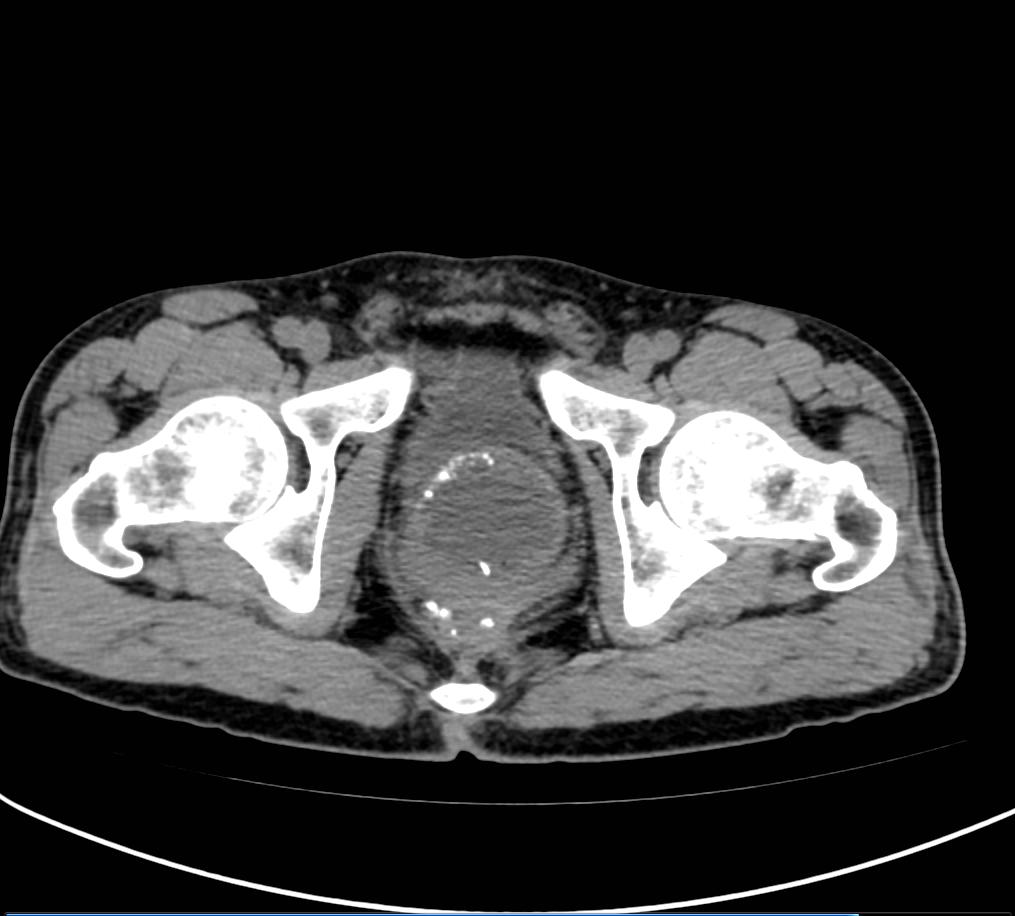 直肠癌保肛术后，吻合口重度狭窄，肛门保卫战