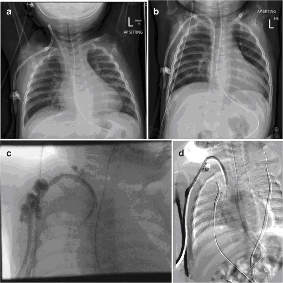 中心静脉导管血栓形成,中心静脉导管是什么