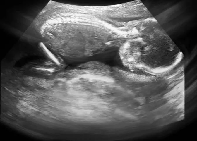 怎样读懂多普勒超声报告单,健康监测体检报告单