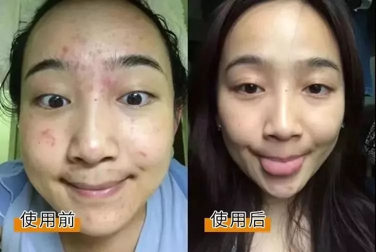 祛痘痘痘印最有效的国货产品,老国货治痘痘
