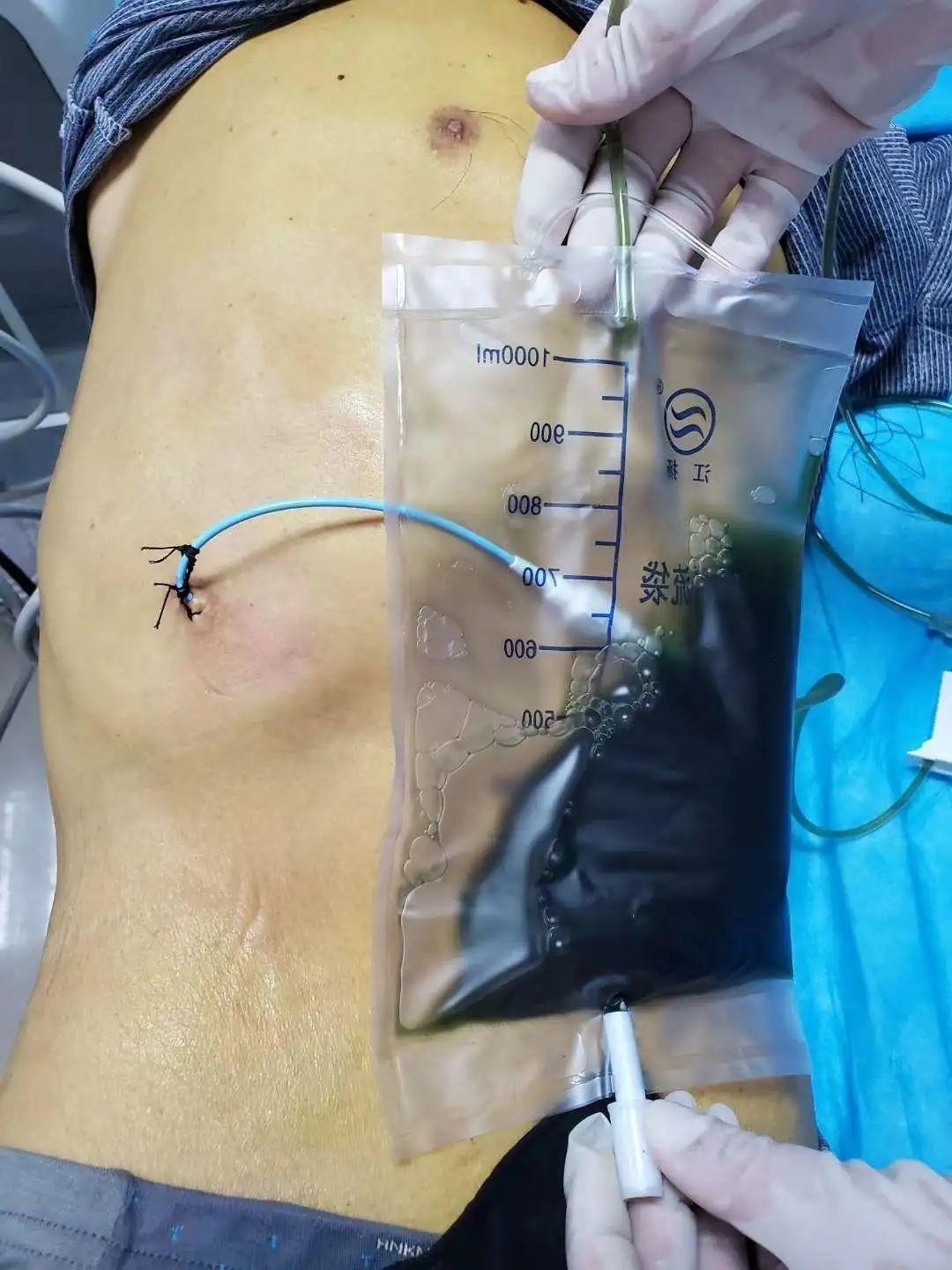 超声介入胆管引流,超声引导下胆道置管引流