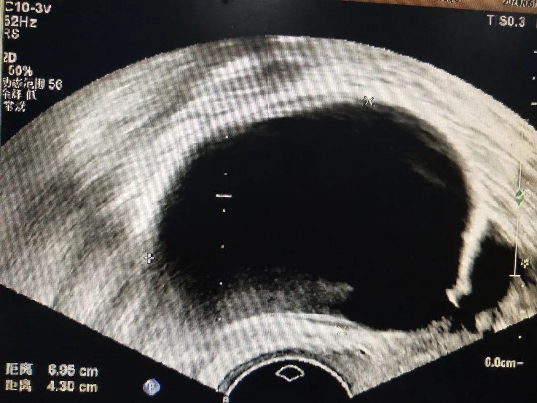 超声介入胆管引流,超声引导下胆道置管引流
