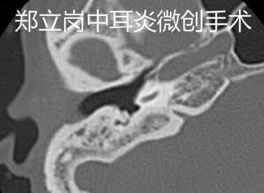 中耳炎穿孔微创手术要剃头发吗,中耳炎鼓膜穿孔湿耳可以做手术吗