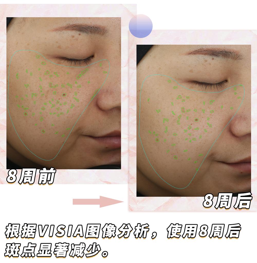 爱长斑的女人怎么办,女生长斑