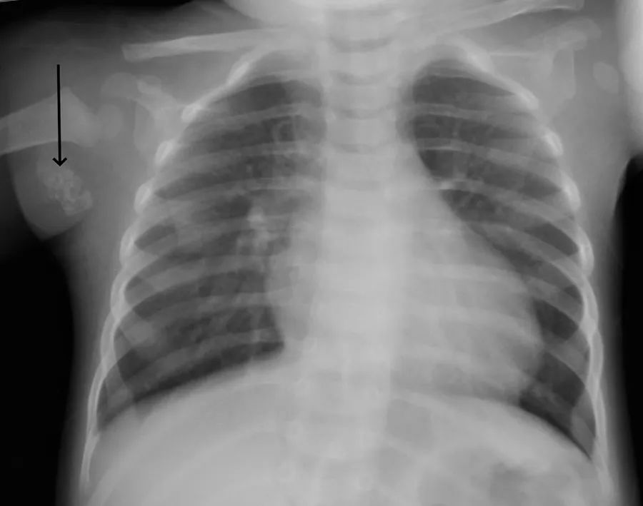 接种卡介苗后疤痕的中间有根粉刺,打了卡介苗腋下有疙瘩