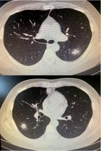 成人肺炎支原体肺炎诊治专家共识,2023肺炎支原体感染中药诊治指南