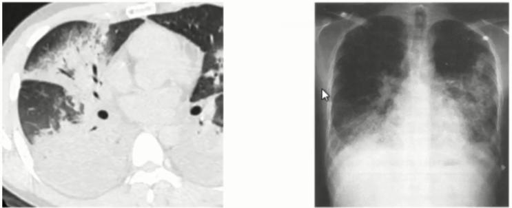 成人肺炎支原体肺炎诊治专家共识,2023肺炎支原体感染中药诊治指南