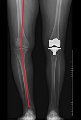 华西膝关节置换,华西医院人工关节置换