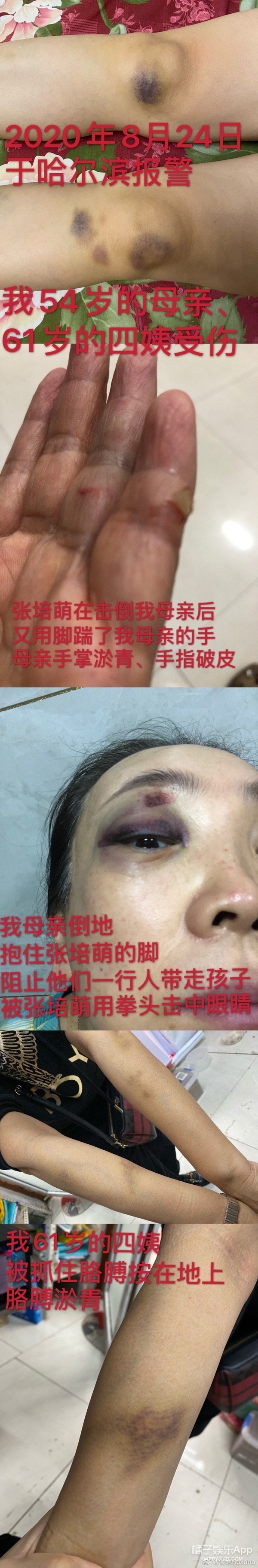 张培萌妻子谈被家暴,张培萌妻子首谈家暴细节全视频