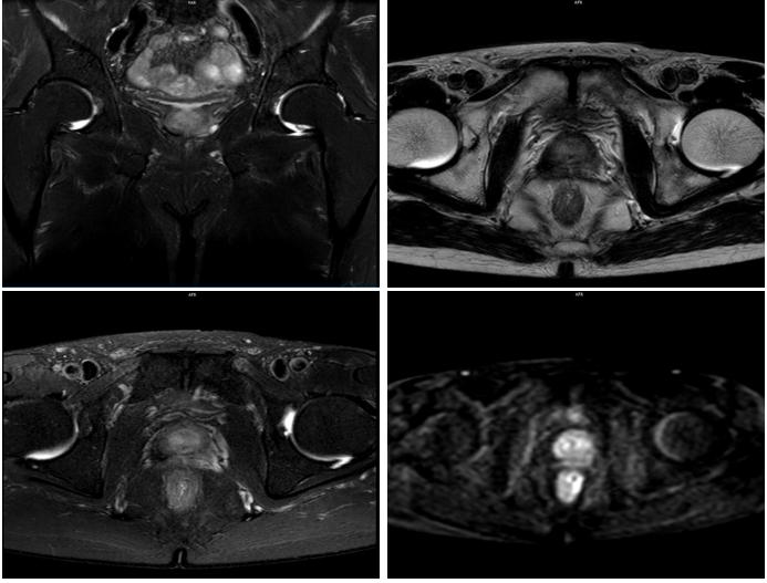 疫情期间进展为mCRPC阶段高危患者，醋酸阿比特龙可迅速控制病情|经典病例