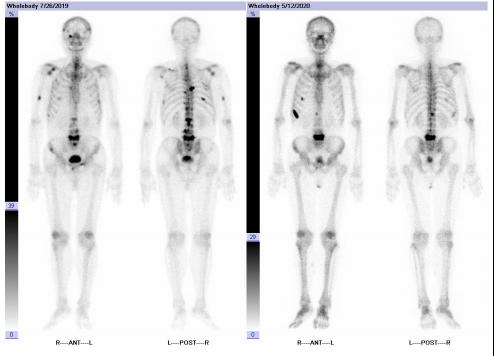 疫情期间进展为mCRPC阶段高危患者，醋酸阿比特龙可迅速控制病情|经典病例