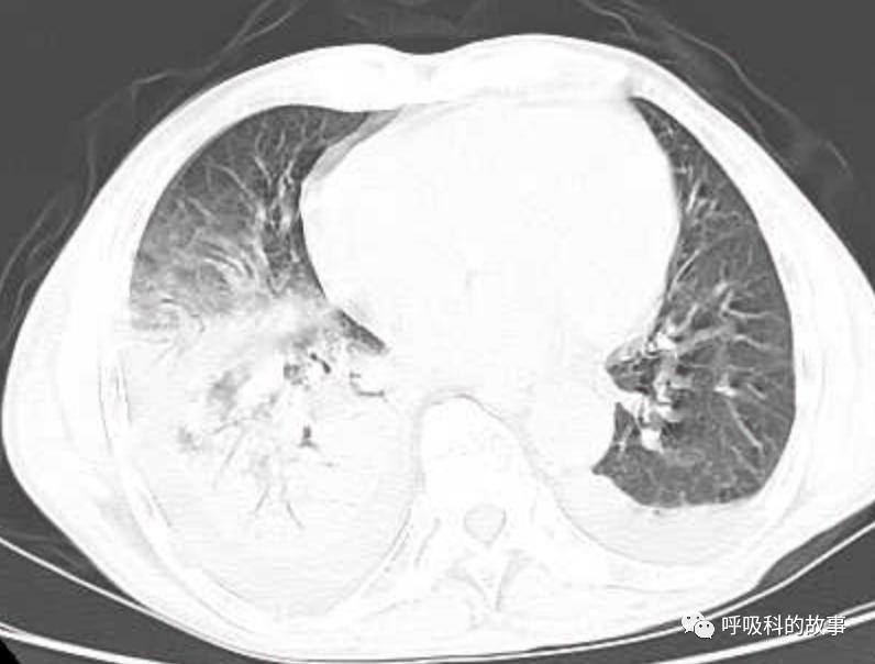 肺炎的最佳治疗方法及药物,肺炎的治疗方法和流程
