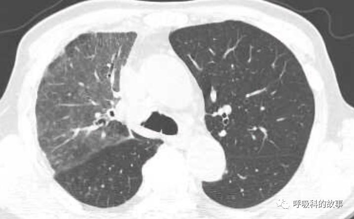 我是如何诊治肺炎的？（4）——如何理解抓住关键信息（2）