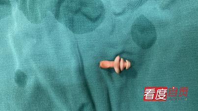 五岁女宝宝有白色的异物还有异味,10岁女童身上有异物