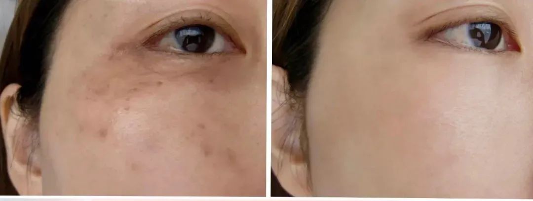 花了3万做激光,才彻底懂了:医生为什么劝你别去斑