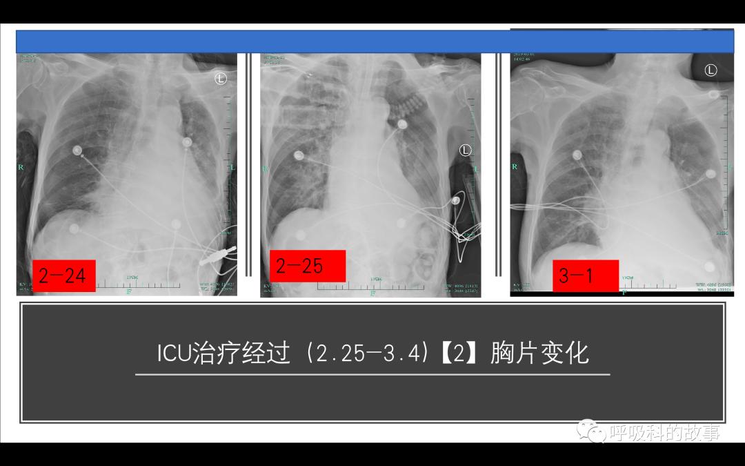 痰液微生物培养注意事项,痰液细菌培养及药敏试验结果