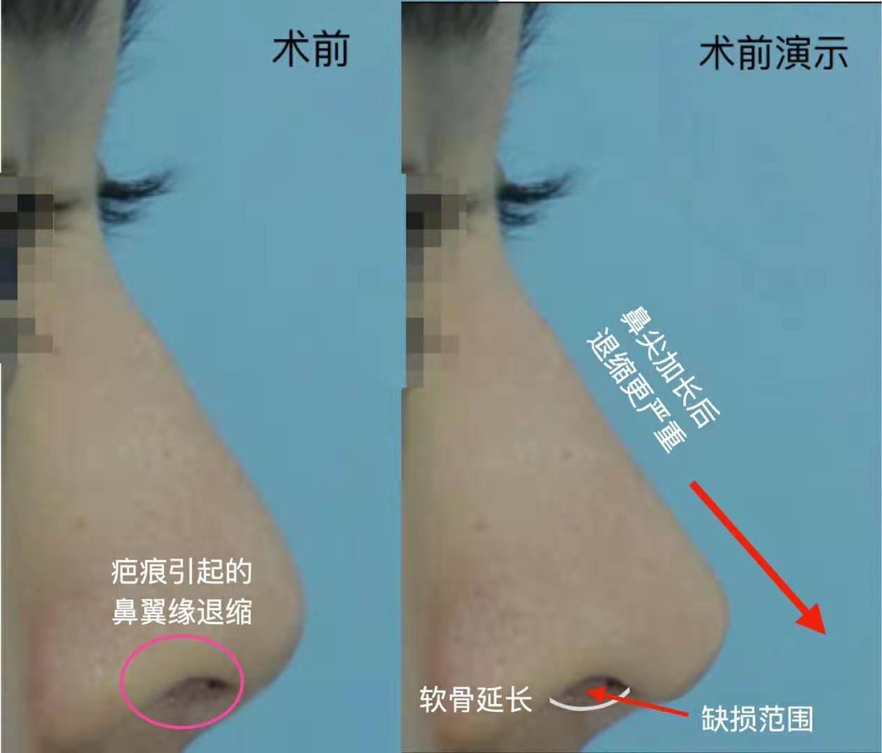 隆鼻鼻尖显形露鼻孔怎么修复,隆鼻修复微驼峰