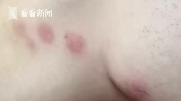 住了民宿发现臭虫,到底是谁之过原版