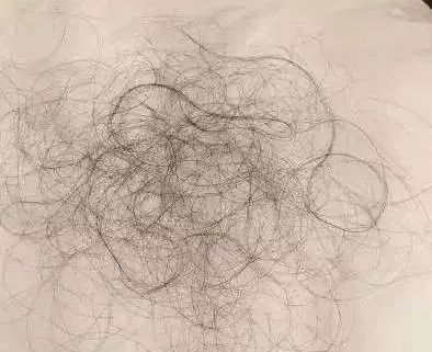 发际线突然变高能补救回来吗,我的发际线该怎么补救