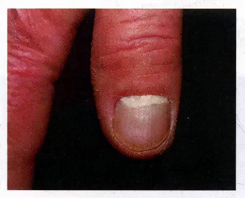 脚指甲盖发黄变厚有竖纹怎么回事,涨知识现象