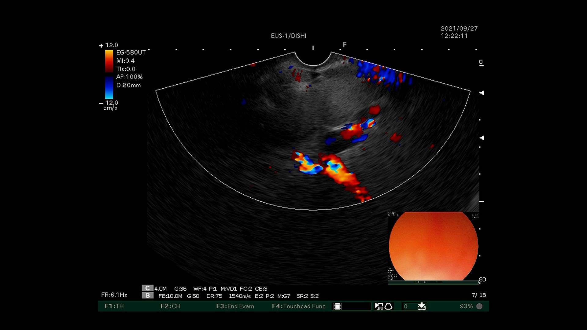毓璜顶医院国内领先开展超声内镜引导下弹簧圈置入联合组织胶栓塞术治疗伴自发分流的巨大胃底静脉曲张