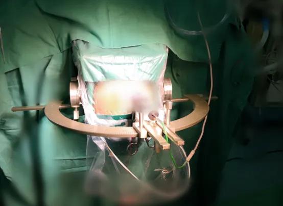 帕金森病应药物联合手术治疗愈后疗效更佳