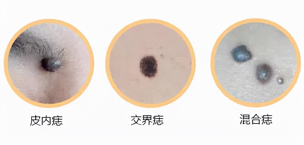 背上的痣长大了会变癌症吗,身上新增好多痣是不是癌症的先兆