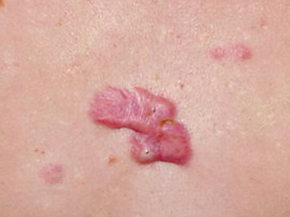 胸前疤痕疙瘩祛疤手术一般多少钱,胸前有一个蝴蝶状疤痕疙瘩怎么治