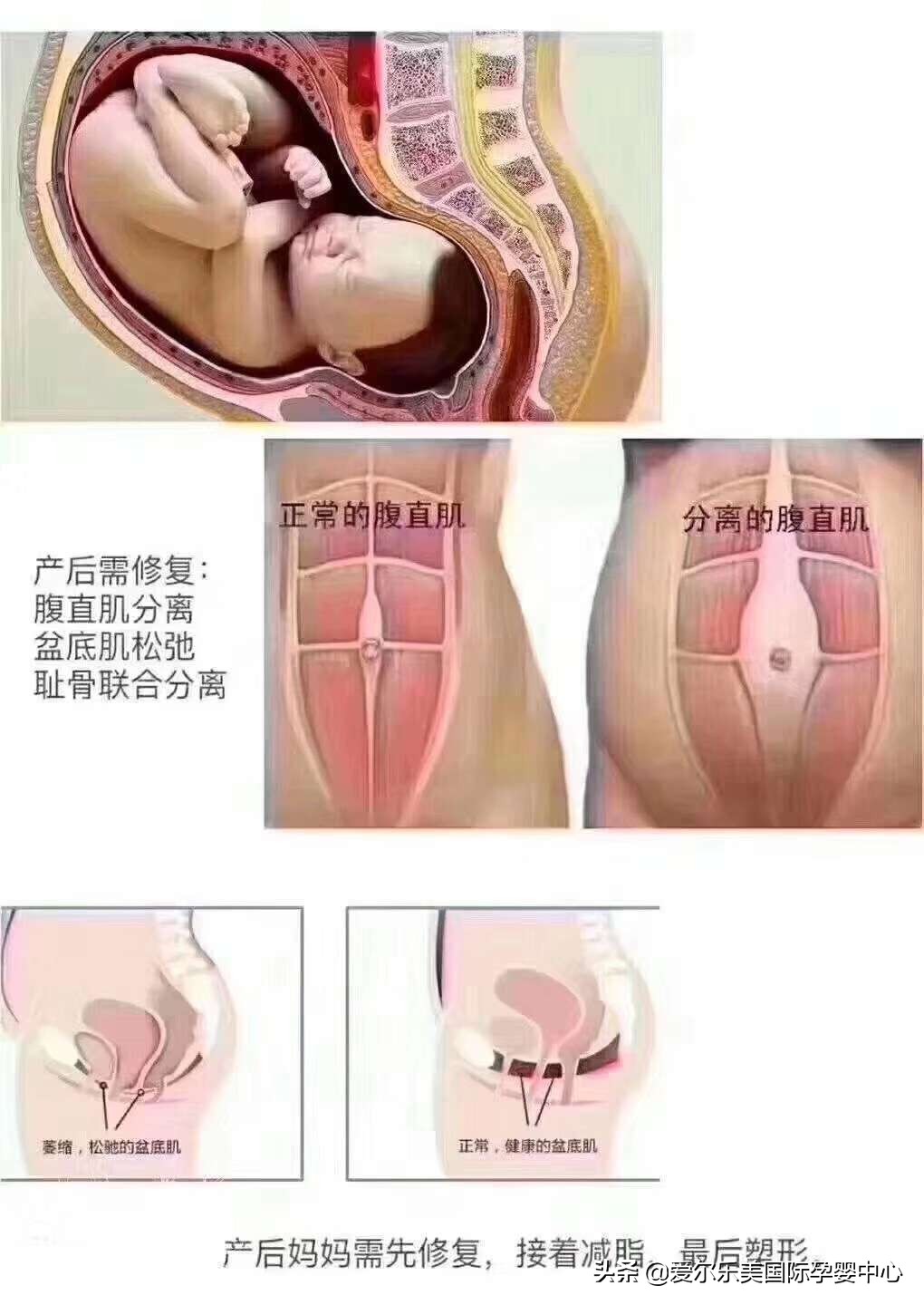 产后不锻炼能自行修复吗,产后不锻炼肚子能恢复吗