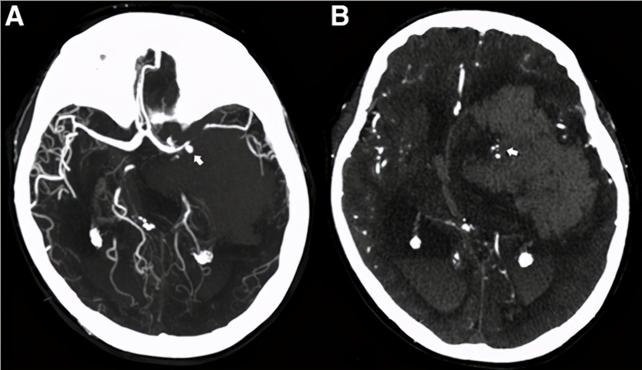 原发性腹膜癌化疗方案,原发性腹膜后肿瘤能做手术吗
