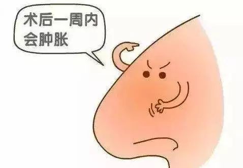 隆鼻选择哪种比较好,这些隆鼻的安全常识你需要知道