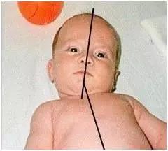 医生说孩子脖子歪了要做康复,三个月宝宝脖子老是歪向一边