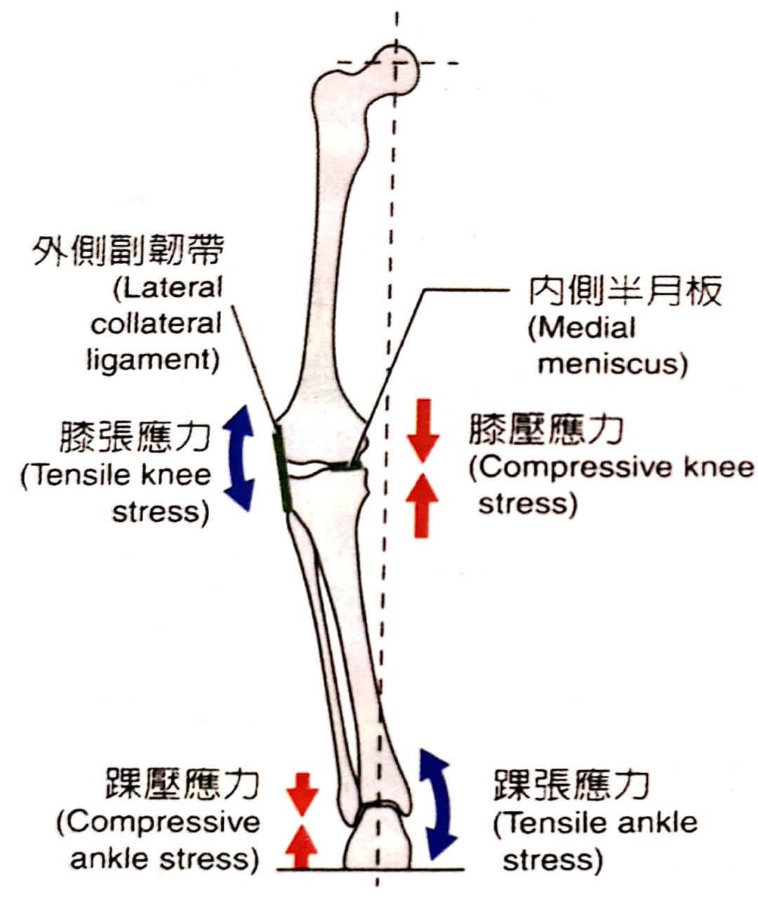 把o型腿变直手术过程,o型腿和xo型腿哪个更难矫正