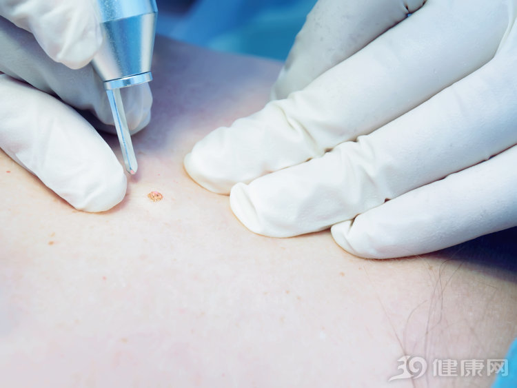 身上长痣用什么药去掉,身上的痣能随便去掉吗