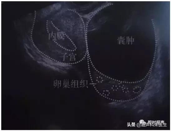 妇科常见疾病的超声诊断视频,超声常见疾病