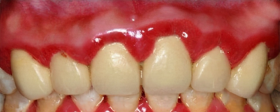 有多少人做了烤瓷牙后悔呀,为什么越来越多人放弃烤瓷牙