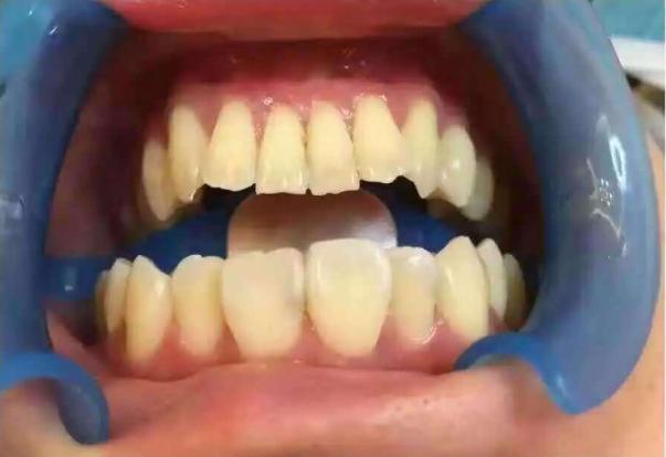 嗑瓜子把牙齿磕裂缝了怎么办,瓜子牙出现小裂痕怎么办