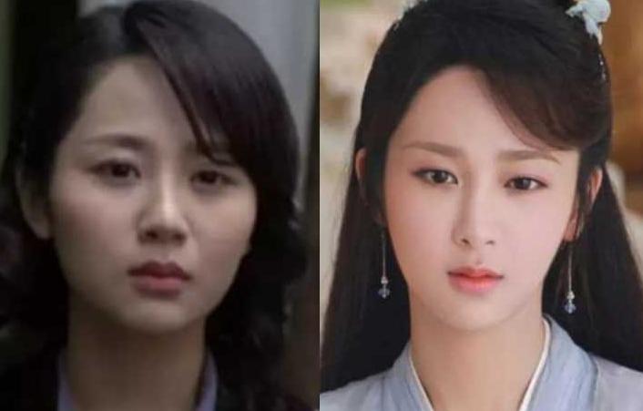 哪个明星做了颧骨内推,颧骨内推明星前后对比