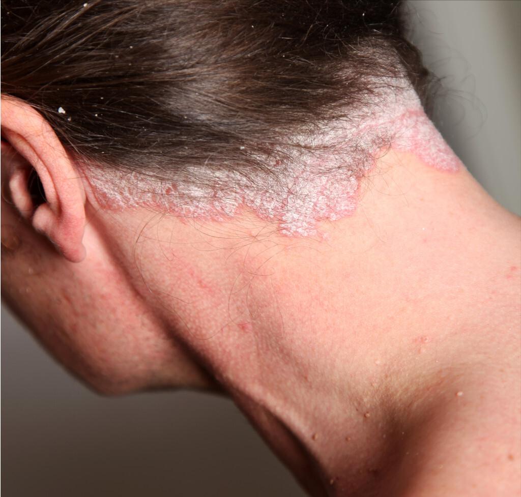 皮肤保湿，在银屑病的治疗过程中非常关键！2个方面一定要做到