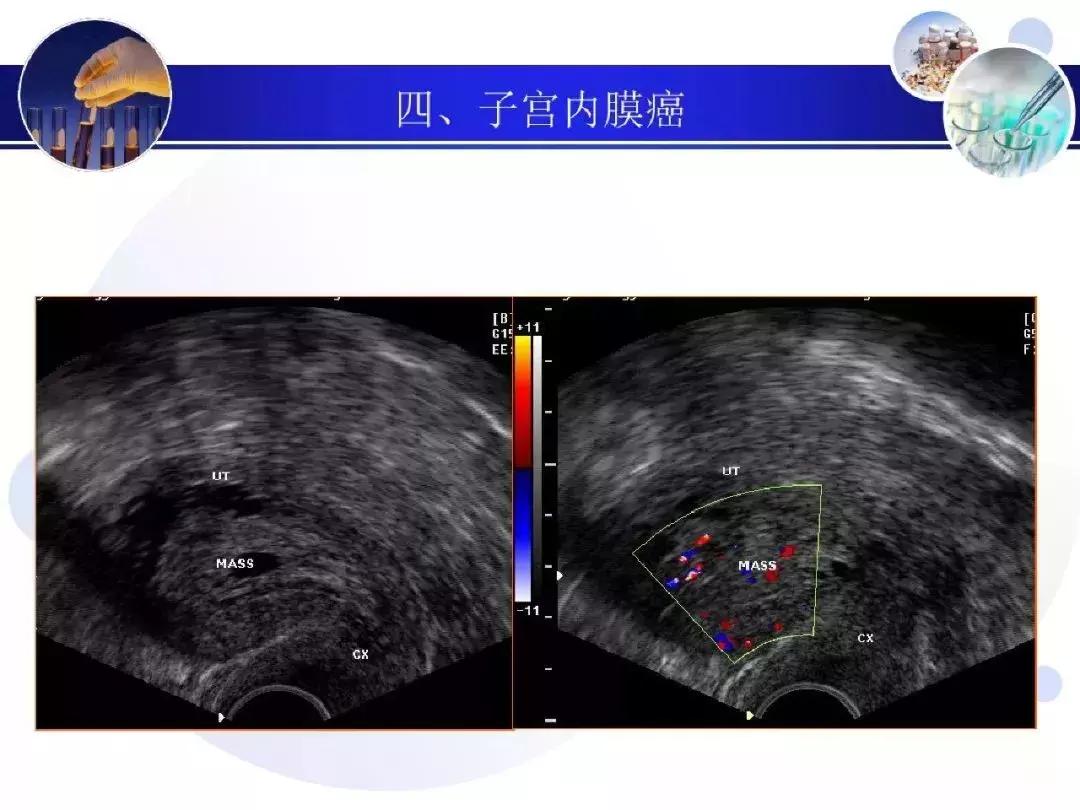 纯干货！子宫及附件解剖和超声诊断