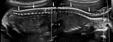 做彩超四维正常胎儿无畸形吗,胎儿脊柱超声几周做