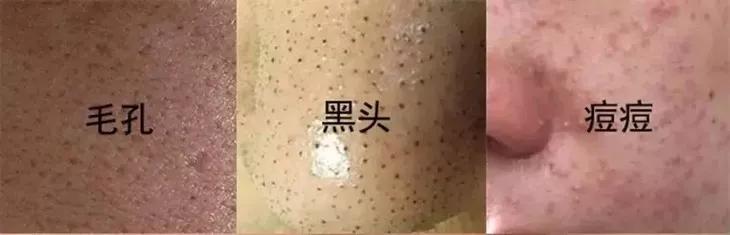 专治螨虫的洗面奶,螨虫专用洁面乳