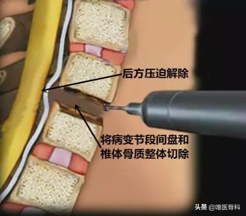 颈椎病做手术哪种方式最好,开放手术和微创手术的区别