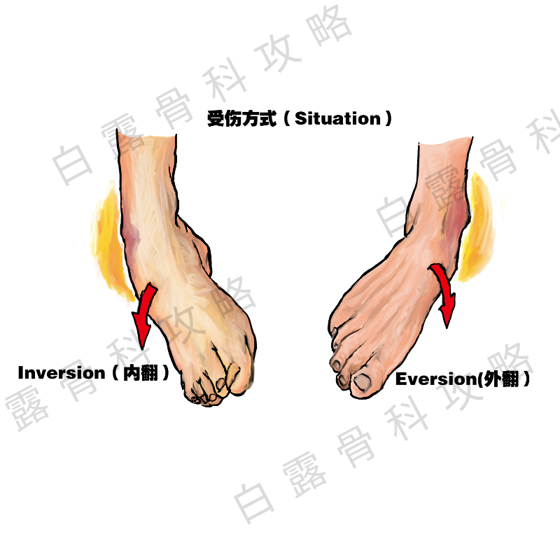 崴脚急诊能处理吗,疫情在家崴脚怎么处理